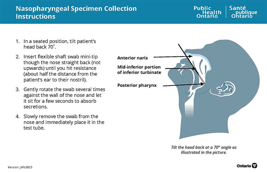Nasopharyngeal Specimen Collection Instructions